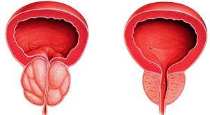 the difference of diseased and healthy prostate