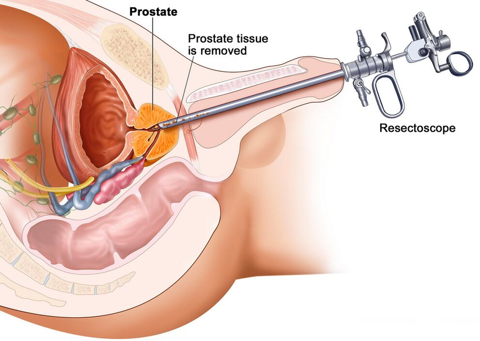 Prostate tissue sampling for accurate diagnosis of prostatitis